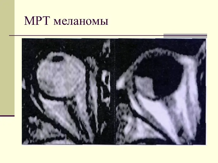МРТ меланомы