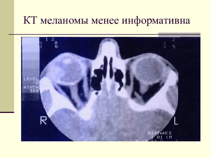 КТ меланомы менее информативна