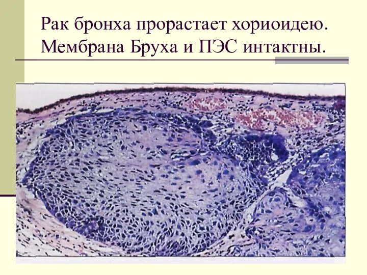 Рак бронха прорастает хориоидею. Мембрана Бруха и ПЭС интактны.