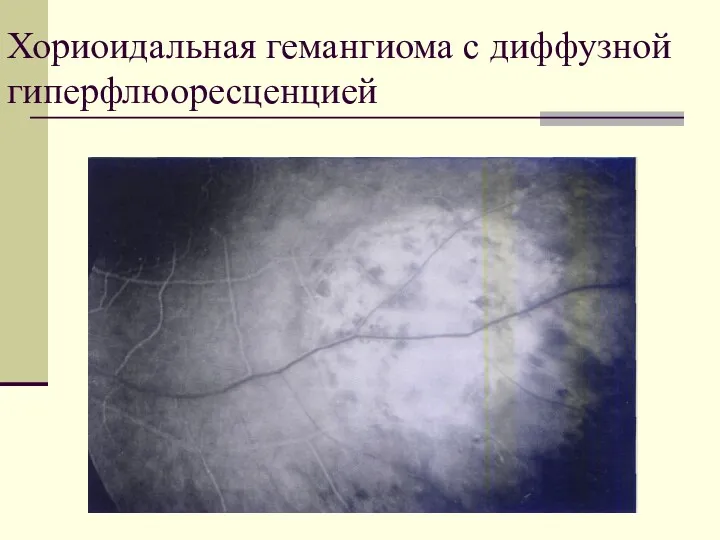 Хориоидальная гемангиома с диффузной гиперфлюоресценцией