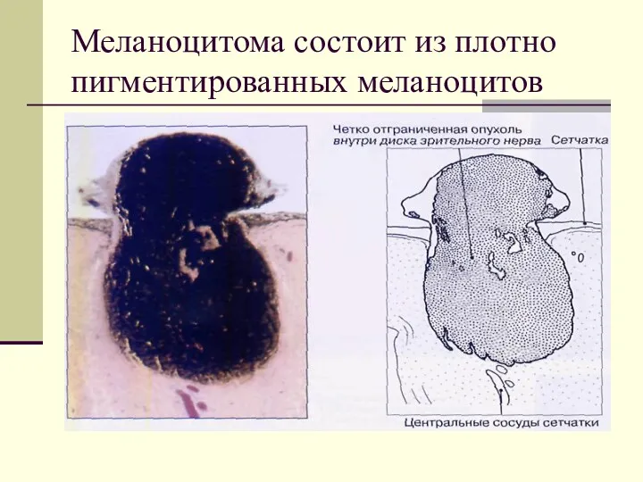 Меланоцитома состоит из плотно пигментированных меланоцитов