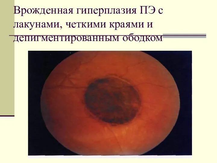 Врожденная гиперплазия ПЭ с лакунами, четкими краями и депигментированным ободком