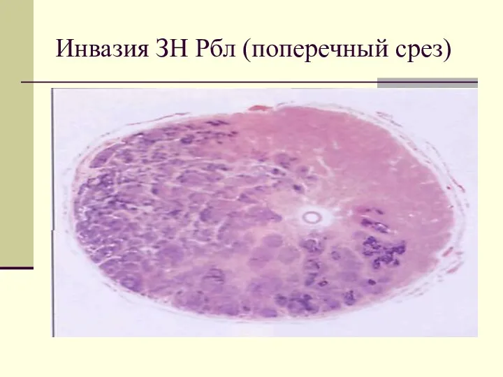 Инвазия ЗН Рбл (поперечный срез)