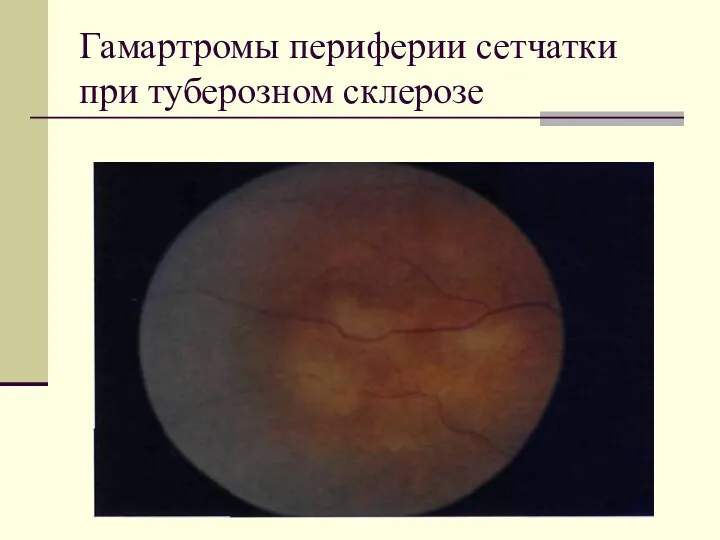 Гамартромы периферии сетчатки при туберозном склерозе