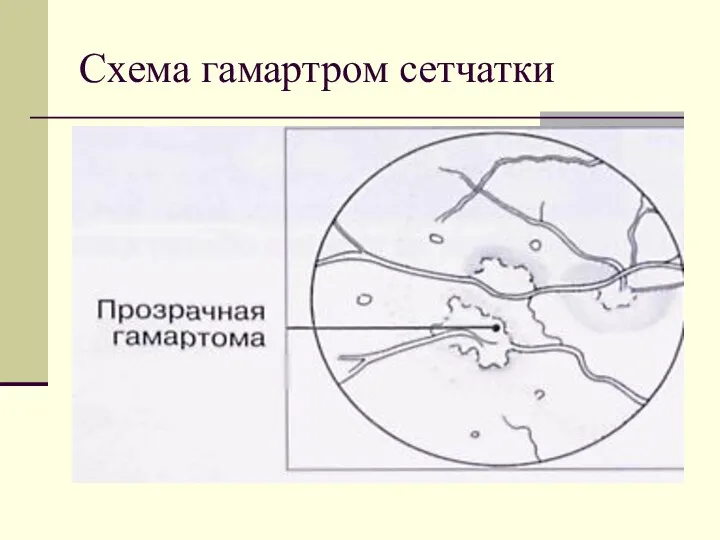 Схема гамартром сетчатки