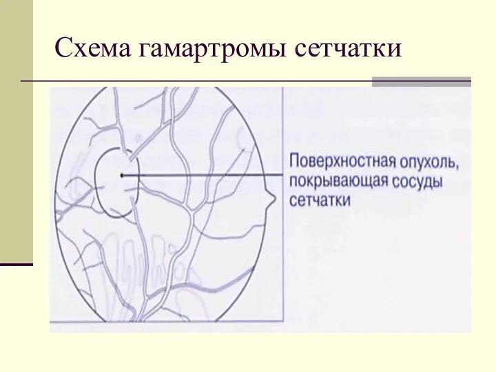 Схема гамартромы сетчатки