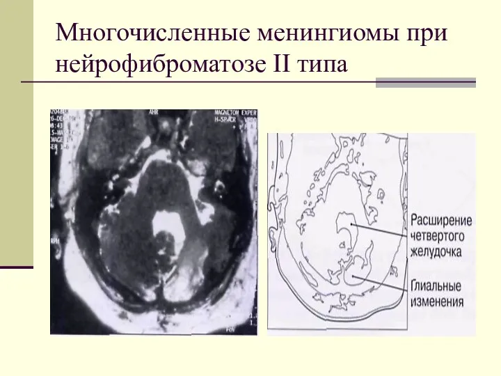 Многочисленные менингиомы при нейрофиброматозе II типа