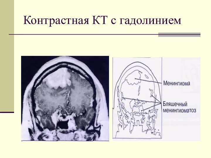 Контрастная КТ с гадолинием