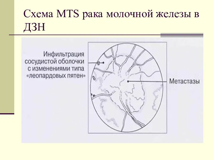 Схема MTS рака молочной железы в ДЗН