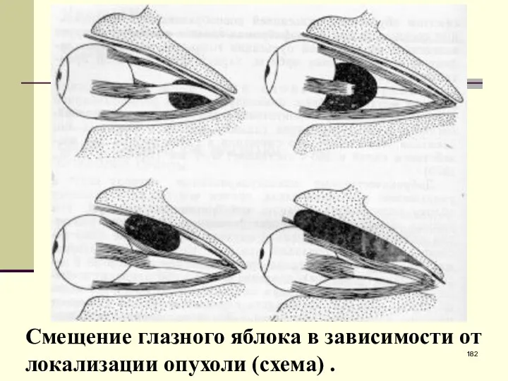 Смещение глазного яблока в зависимости от локализации опухоли (схема) .