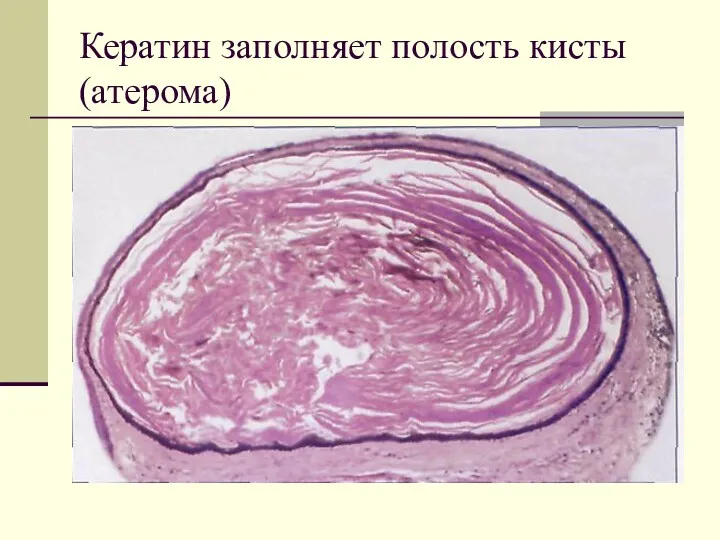 Кератин заполняет полость кисты (атерома)