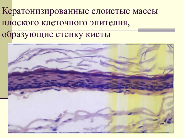 Кератонизированные слоистые массы плоского клеточного эпителия, образующие стенку кисты