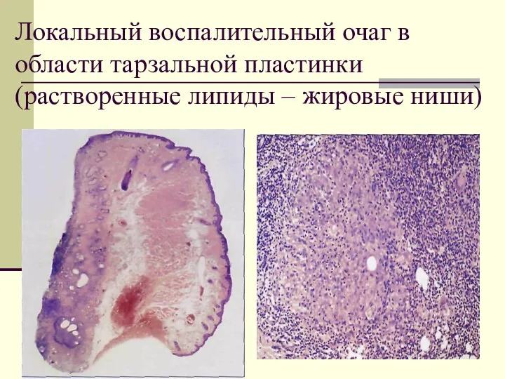 Локальный воспалительный очаг в области тарзальной пластинки (растворенные липиды – жировые ниши)