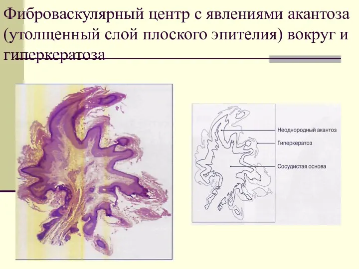 Фиброваскулярный центр с явлениями акантоза (утолщенный слой плоского эпителия) вокруг и гиперкератоза