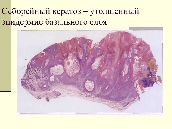 Себорейный кератоз – утолщенный эпидермис базального слоя