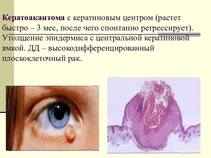 Кератоакантома с кератиновым центром (растет быстро – 3 мес, после
