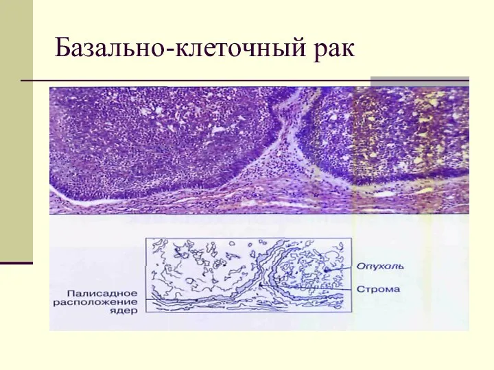 Базально-клеточный рак