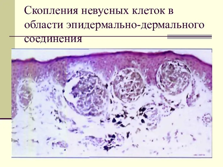 Скопления невусных клеток в области эпидермально-дермального соединения