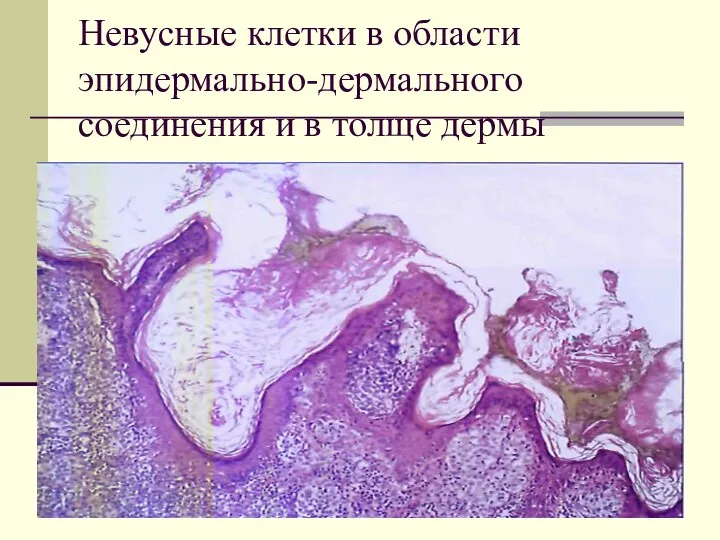 Невусные клетки в области эпидермально-дермального соединения и в толще дермы