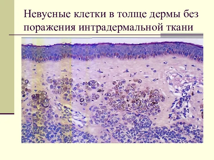 Невусные клетки в толще дермы без поражения интрадермальной ткани