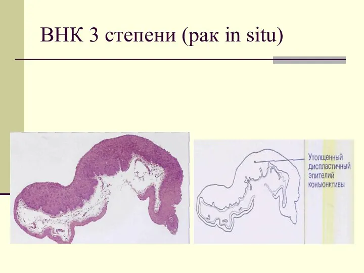 ВНК 3 степени (рак in situ)