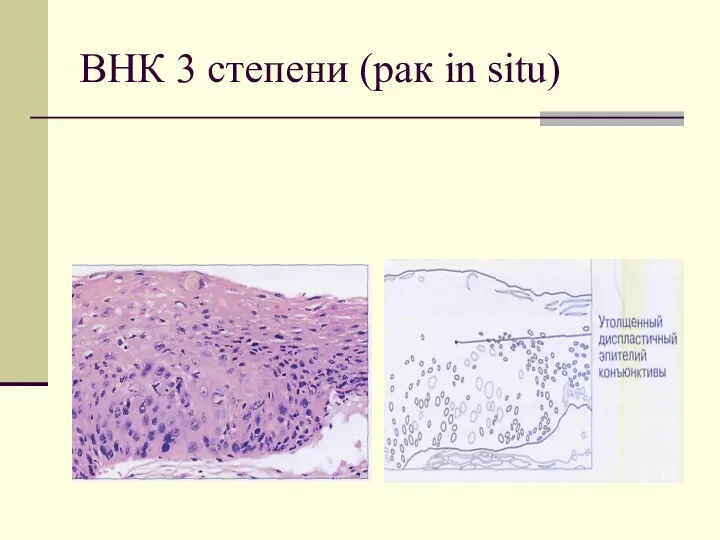 ВНК 3 степени (рак in situ)