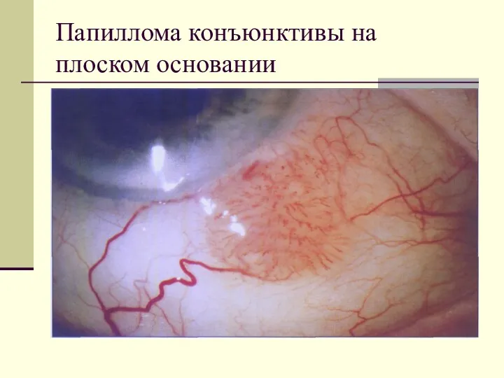 Папиллома конъюнктивы на плоском основании