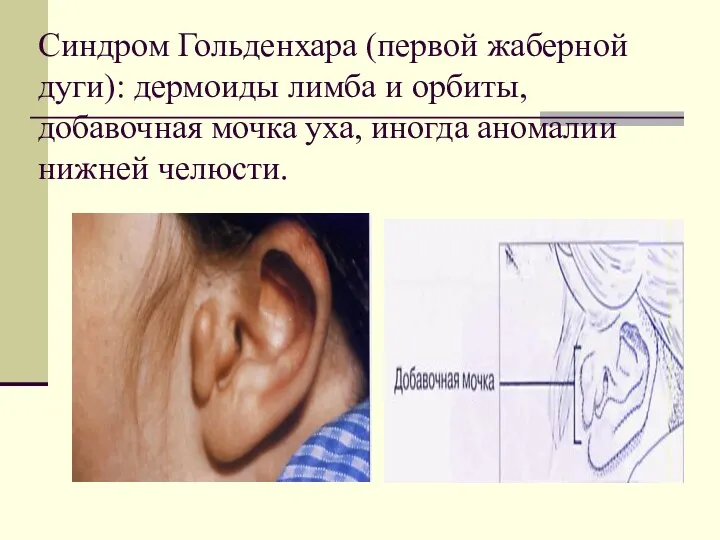 Синдром Гольденхара (первой жаберной дуги): дермоиды лимба и орбиты, добавочная мочка уха, иногда аномалии нижней челюсти.