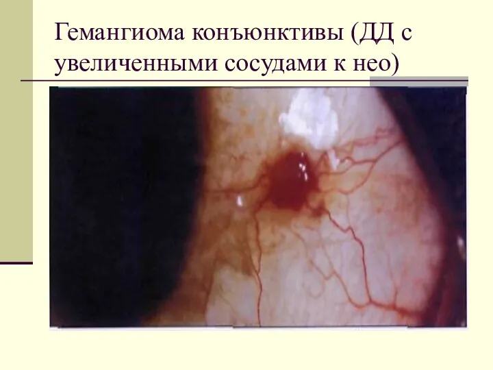 Гемангиома конъюнктивы (ДД с увеличенными сосудами к нео)