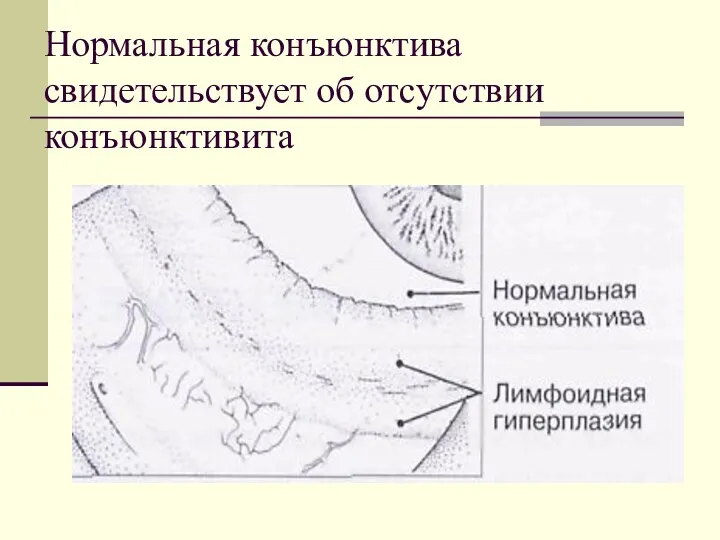 Нормальная конъюнктива свидетельствует об отсутствии конъюнктивита