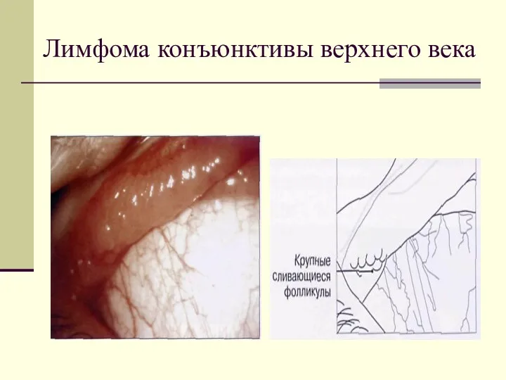 Лимфома конъюнктивы верхнего века