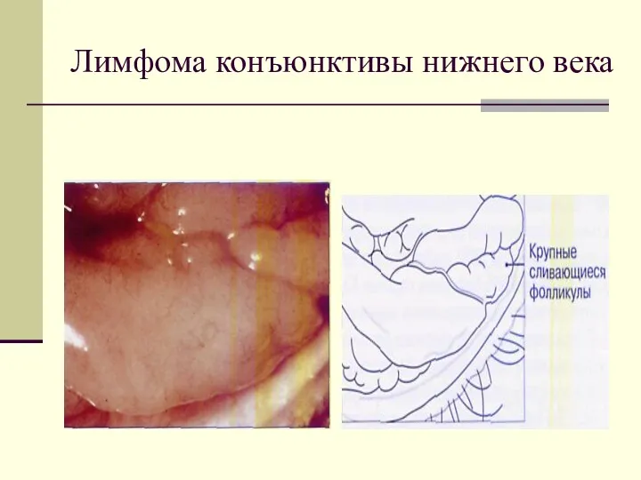 Лимфома конъюнктивы нижнего века