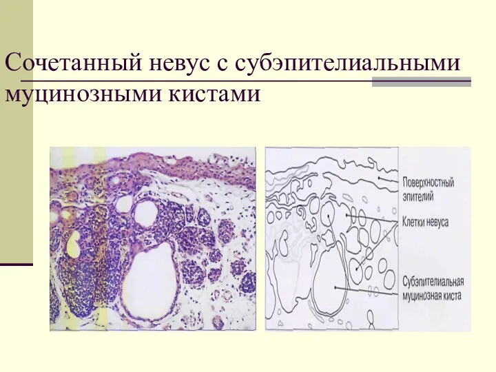 Сочетанный невус с субэпителиальными муцинозными кистами