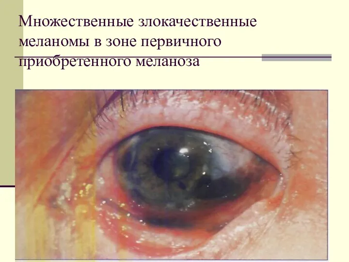 Множественные злокачественные меланомы в зоне первичного приобретенного меланоза