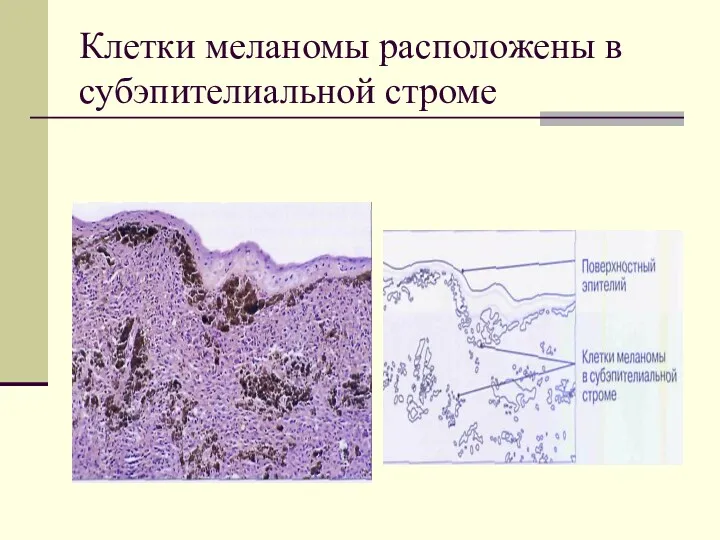 Клетки меланомы расположены в субэпителиальной строме