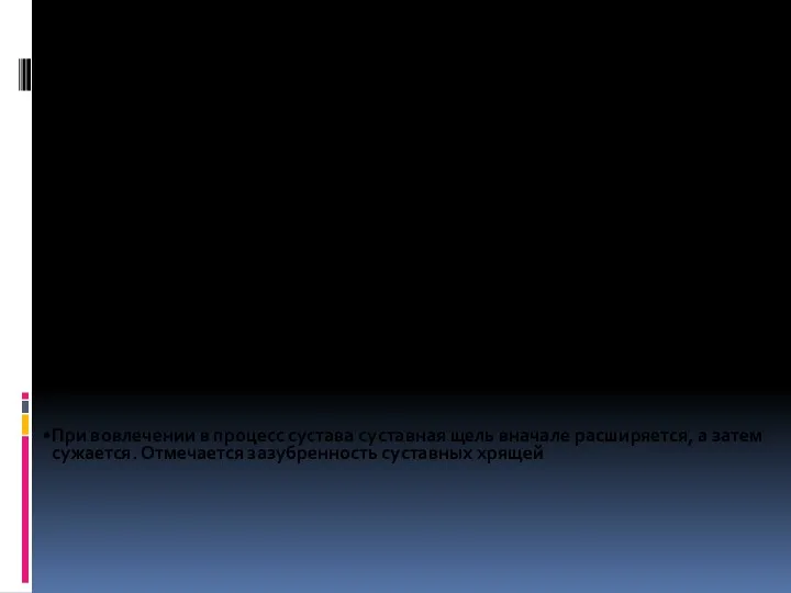 изменения в области метаэпифиза: остеопороз, секвестры на фоне участка просветления