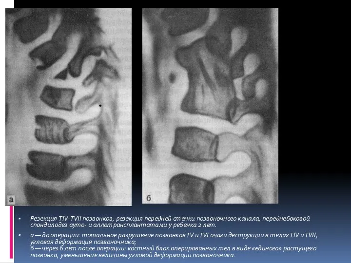 Резекция TIV-ТVII позвонков, резекция передней стенки позвоночного канала, переднебоковой спондилодез