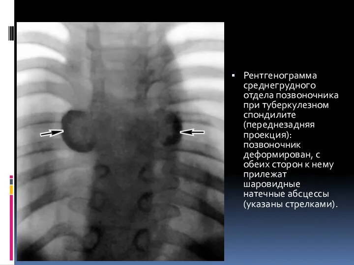 Рентгенограмма среднегрудного отдела позвоночника при туберкулезном спондилите (переднезадняя проекция): позвоночник