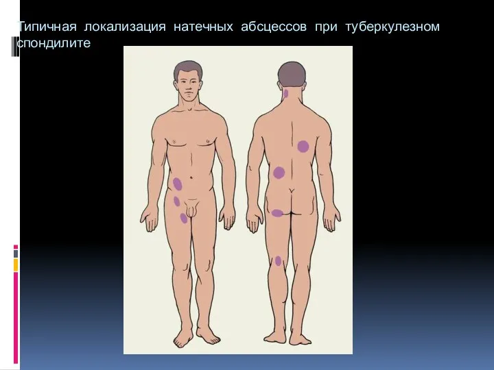 Типичная локализация натечных абсцессов при туберкулезном спондилите