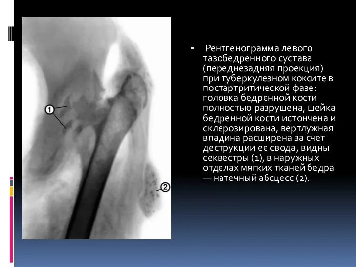 Рентгенограмма левого тазобедренного сустава (переднезадняя проекция) при туберкулезном коксите в