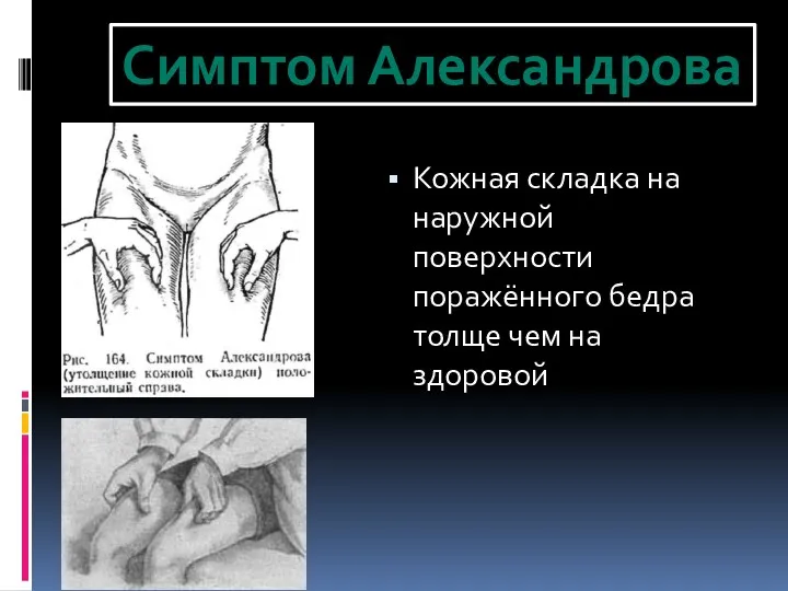 Кожная складка на наружной поверхности поражённого бедра толще чем на здоровой Симптом Александрова