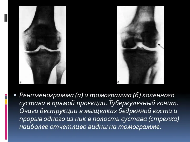 Рентгенограмма (а) и томограмма (б) коленного сустава в прямой проекции.