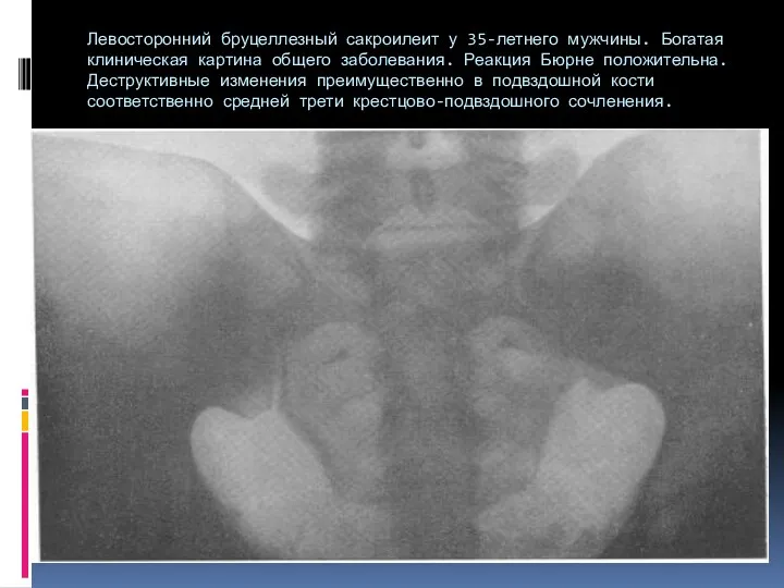 Левосторонний бруцеллезный сакроилеит у 35-летнего мужчины. Богатая клиническая картина общего