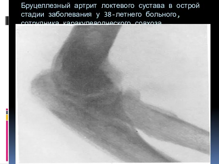 Бруцеллезный артрит локтевого сустава в острой стадии заболевания у 38-летнего больного, сотрудника каракулеводческого совхоза.