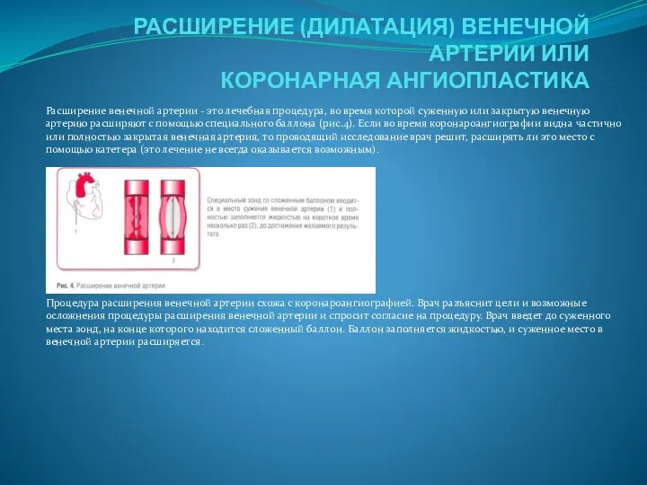 РАСШИРЕНИЕ (ДИЛАТАЦИЯ) ВЕНЕЧНОЙ АРТЕРИИ ИЛИ КОРОНАРНАЯ АНГИОПЛАСТИКА Расширение венечной артерии