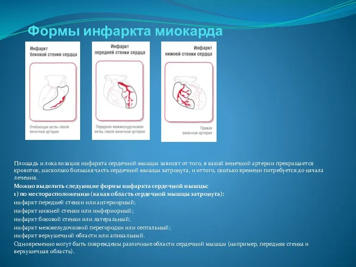 Формы инфаркта миокарда Площадь и локализация инфаркта сердечной мышцы зависят