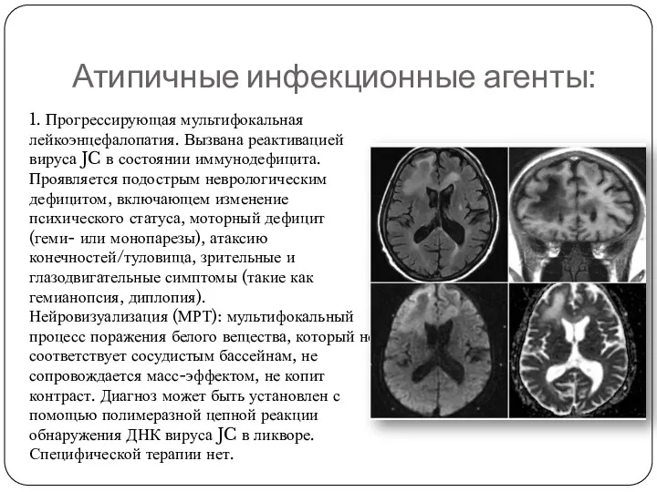 1. Прогрессирующая мультифокальная лейкоэнцефалопатия. Вызвана реактивацией вируса JC в состоянии