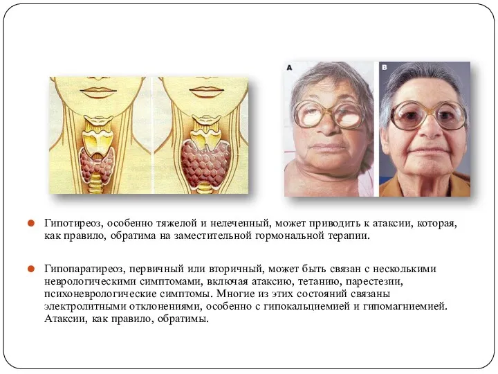 Гипотиреоз, особенно тяжелой и нелеченный, может приводить к атаксии, которая,