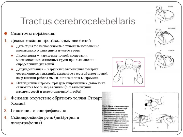 Tractus cerebrocelebellaris Симптомы поражения: Декомпенсация произвольных движений Дисметрия т.е.неспособность остановить