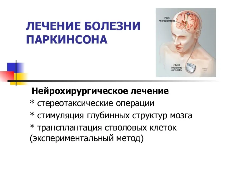ЛЕЧЕНИЕ БОЛЕЗНИ ПАРКИНСОНА Нейрохирургическое лечение * стереотаксические операции * стимуляция глубинных структур мозга